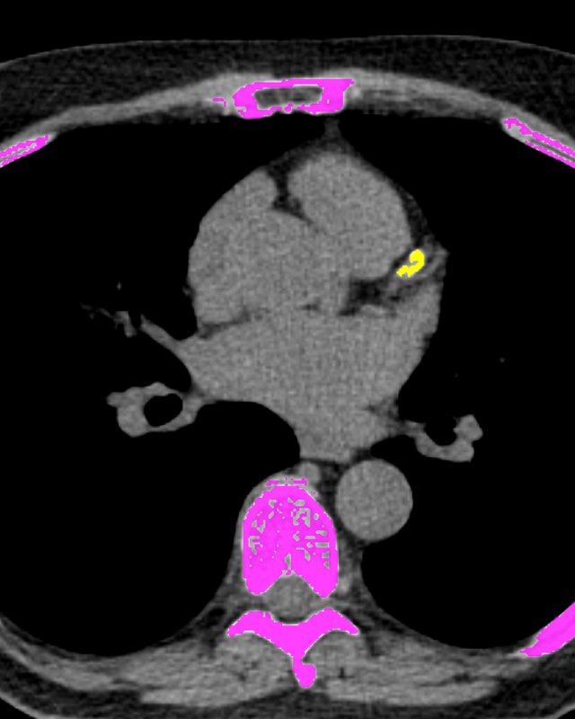 Calcium score CT scan of the heart, with calcium in a coronary artery marked in yellow