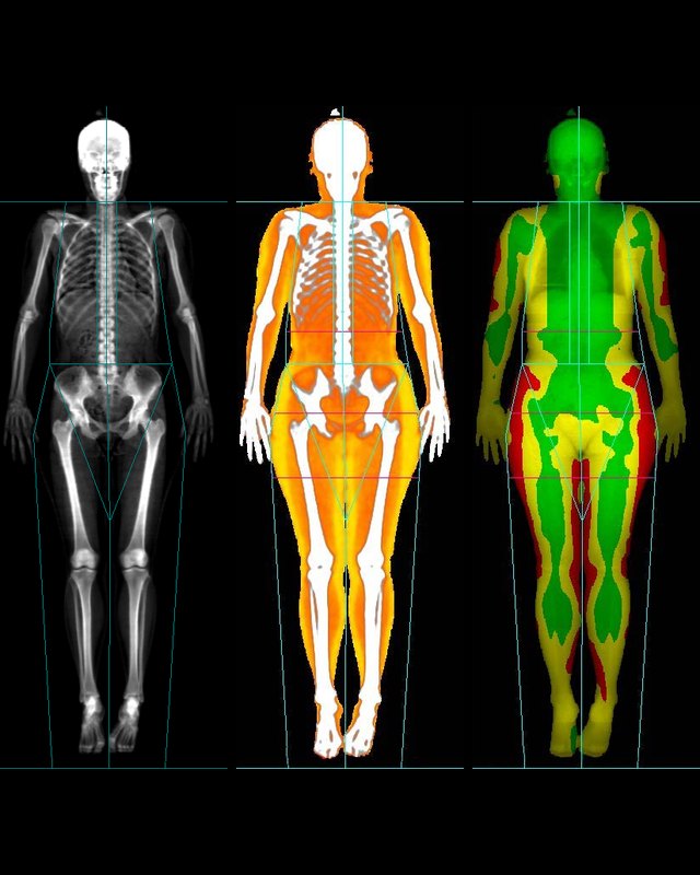 Whole-body DEXA scans: the skeleton, and color maps of bone, fat and lean tissue