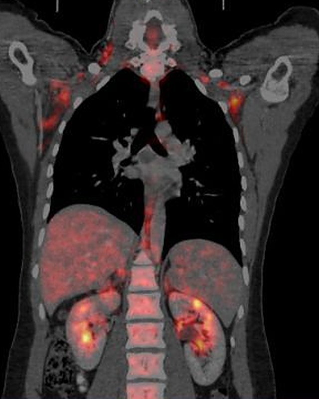 PET-CT scan of the body, with the PET image laid over the CT