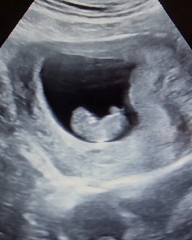 Ultrasound image from a pregnancy scan