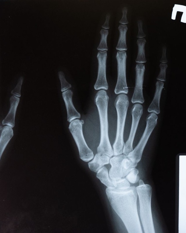 X-ray image of a hand